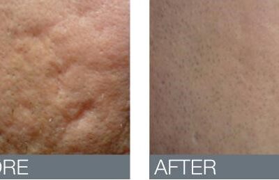 thermage before and after